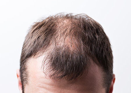 درمان ریزش مو را در اولویت های زندگیتان قرار دهید