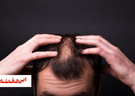 فریب سودجو ها در زمینه کاشت مو را نخورید